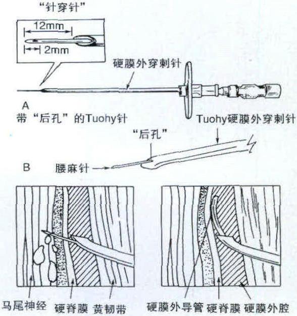 图3-2-5 蛛网膜下腔—硬膜外联合阻滞